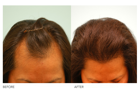 Female Hairline Lowering