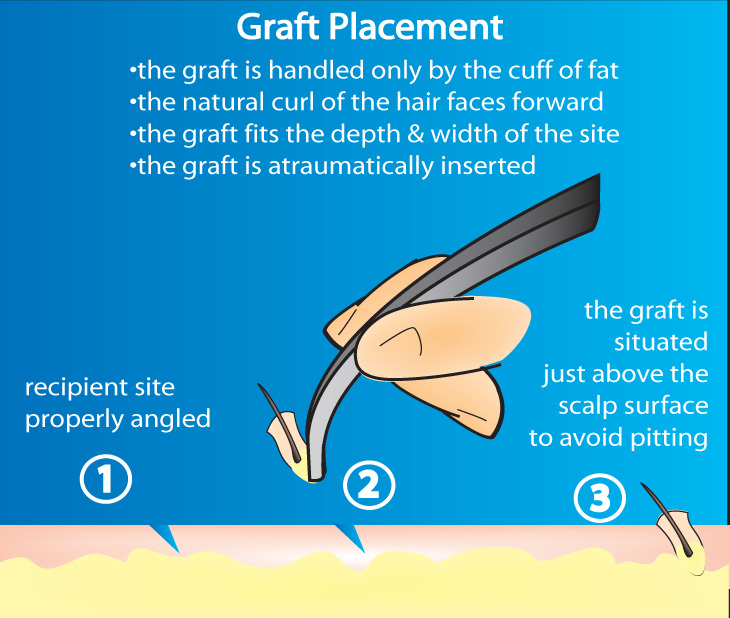 graft-placement-drawing