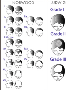 hair-loss-grade-scale