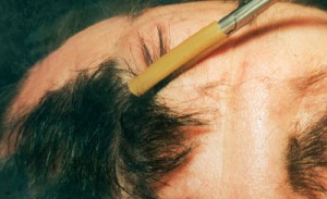 Hair Pluck Test hair_pluck_test
