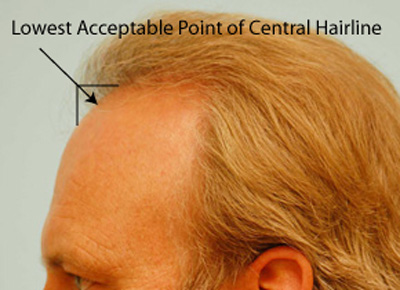 hairline-design