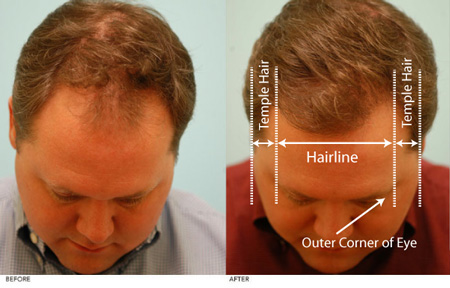 hairline_limits