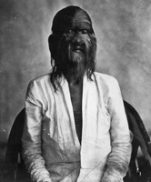 hypertrichosis-2