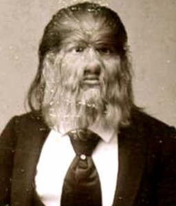 hypertrichosis-5