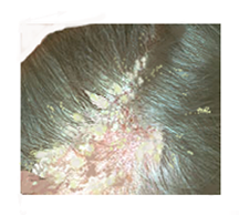 scalp-pityriasis