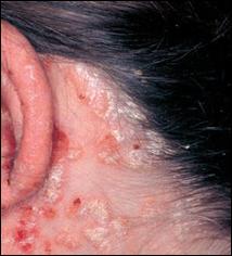scalp-psoriasis