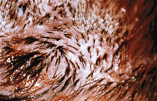 scarring-tufted-folliculitis