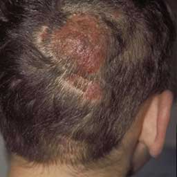 Tinea Capitis Dallas | Fungal Infection of the Scalp Plano, TX