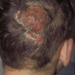 Tinea Capitis Dallas | Fungal Infection of the Scalp Plano, TX Tinea Capitis Dallas | Fungal Infection of the Scalp Plano, TX
