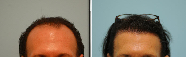 transgender hair transplant frontal view
