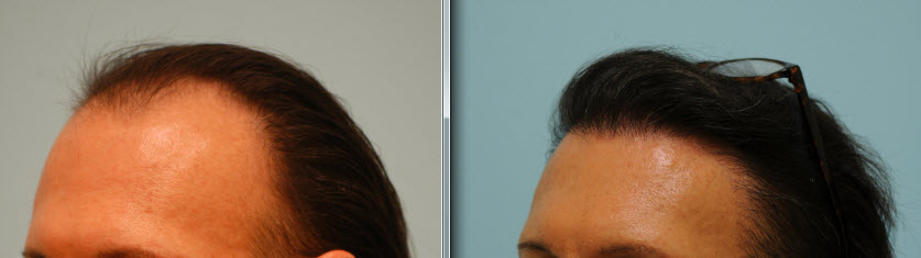 Transgender Hair Transplant - Left View Transgender Hair Transplant Frontal view Before & After Dallas