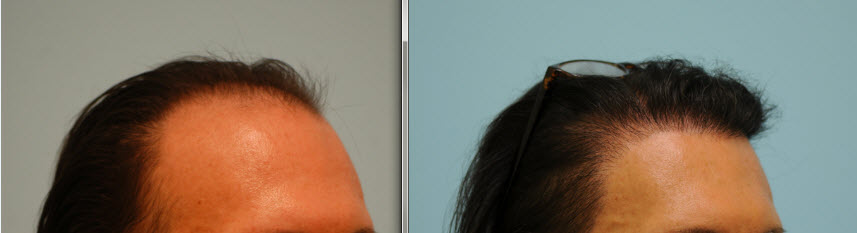 transgender hair transplant - right view Transgender Hair Transplant Frontal view Before & After Dallas