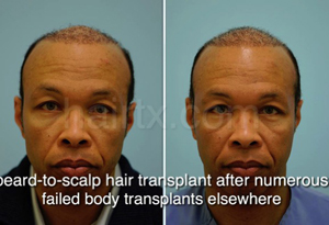 Body Hair Transplant Results Dallas