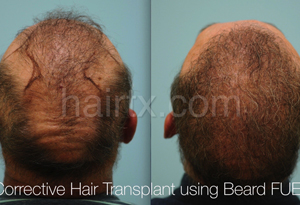 Body Hair Transplant Results Dallas