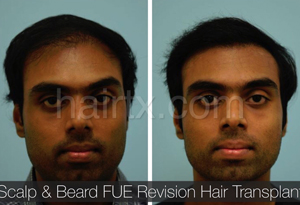 Body Hair Transplant Results Dallas