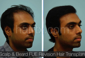 Body Hair Transplant Results Dallas