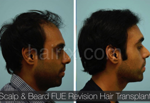 Body Hair Transplant Results Dallas