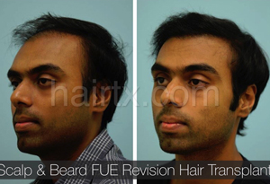 Body Hair Transplant Results Dallas