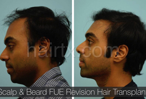 Body Hair Transplant Results Dallas