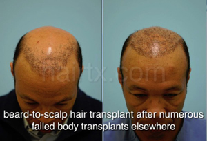Body Hair Transplant Results Dallas