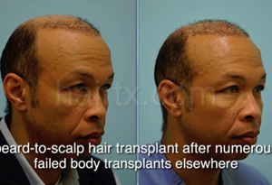 Body Hair Transplant Results Dallas