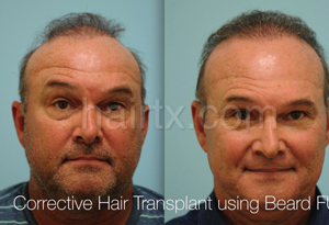 Body Hair Transplant Results Dallas