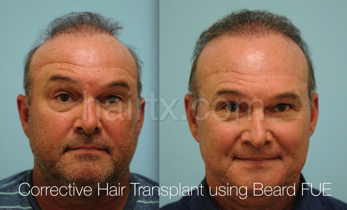 Body Hair Transplant Dallas | Hair Transplant Plano, Tx