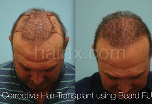 Body Hair Transplant Results Dallas