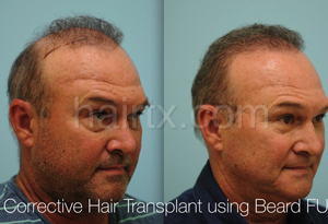 Body Hair Transplant Results Dallas