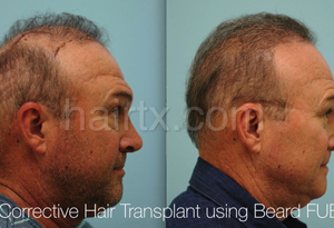 Body Hair Transplant Results Dallas