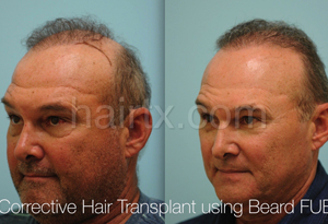 Body Hair Transplant Results Dallas