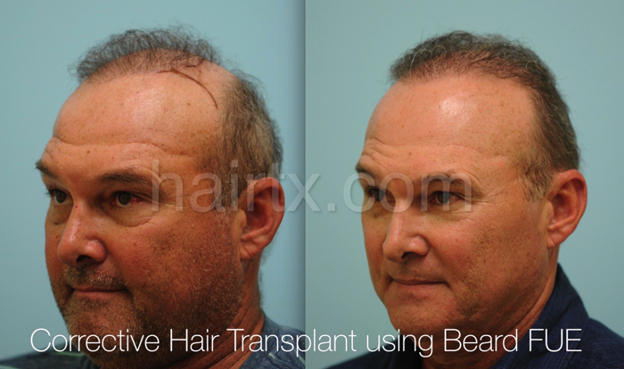 Body Hair Transplant Dallas | Hair Transplant Plano, Tx