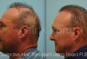 Body Hair Transplant Results Dallas