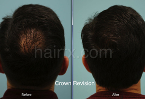 Crown Revision Before and After Corrective Hair Transplants
