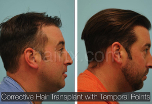 Corrective Hair Transplants with Temporal Points