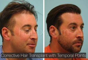 Corrective Hair Transplants with Temporal Points