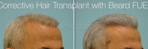 Corrective Hair Transplants using Beard FUE
