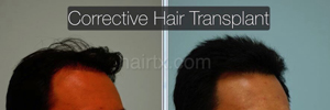 Corrective Hair Transplants Dallas