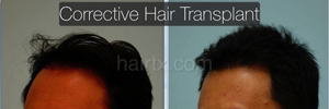 Corrective Hair Transplants Dallas