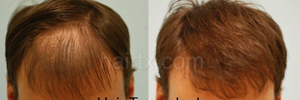 Corrective Hair Transplants Dallas Before and After Photo