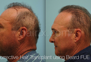Corrective Hair Transplants using Beard FUE