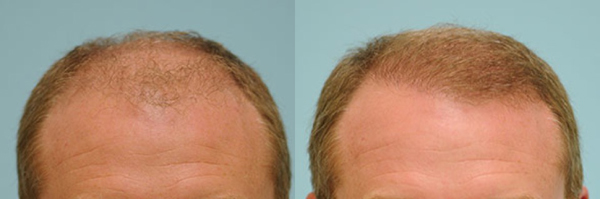 Balding Man Before and After Corrective Hair Transplants