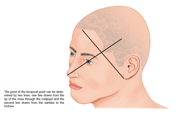 Temporal POint for Corrective Hair Transplants