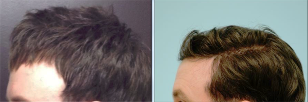 Side View of a Man Before and After Corrective Hair Transplants