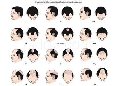 Classification of Hair Loss for Men