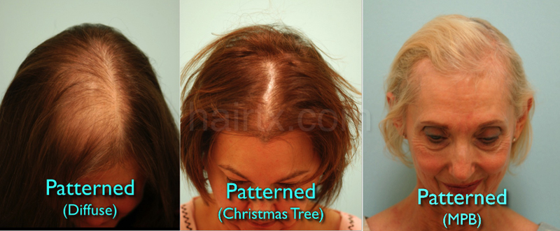 Hair Restoration Plano Tx