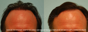 Man Corrective Hair Transplants Before and After Photos