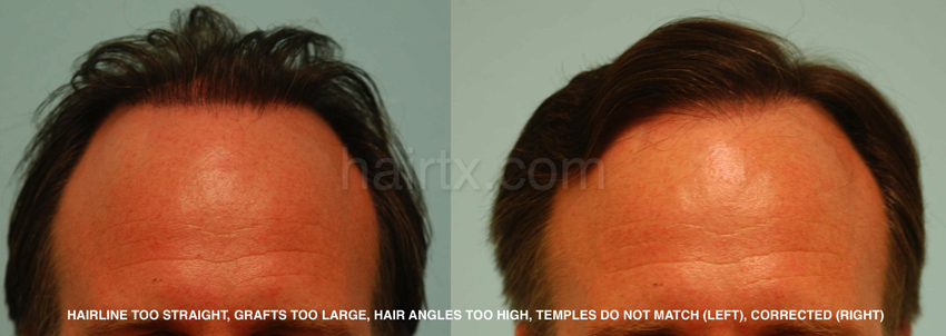 Corrective Hair Transplants Dallas | Corrective Hair Surgery Plano, Tx
