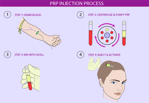 PRP Injection Process