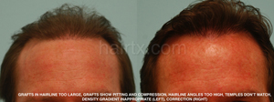Man's Corrective Hair Transplants Before and After Photos